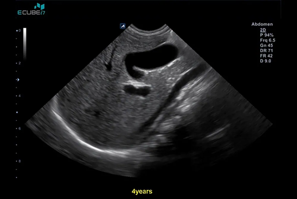 2-Gallbladder-in-pediatric-liver-with-C5-8T-transducer