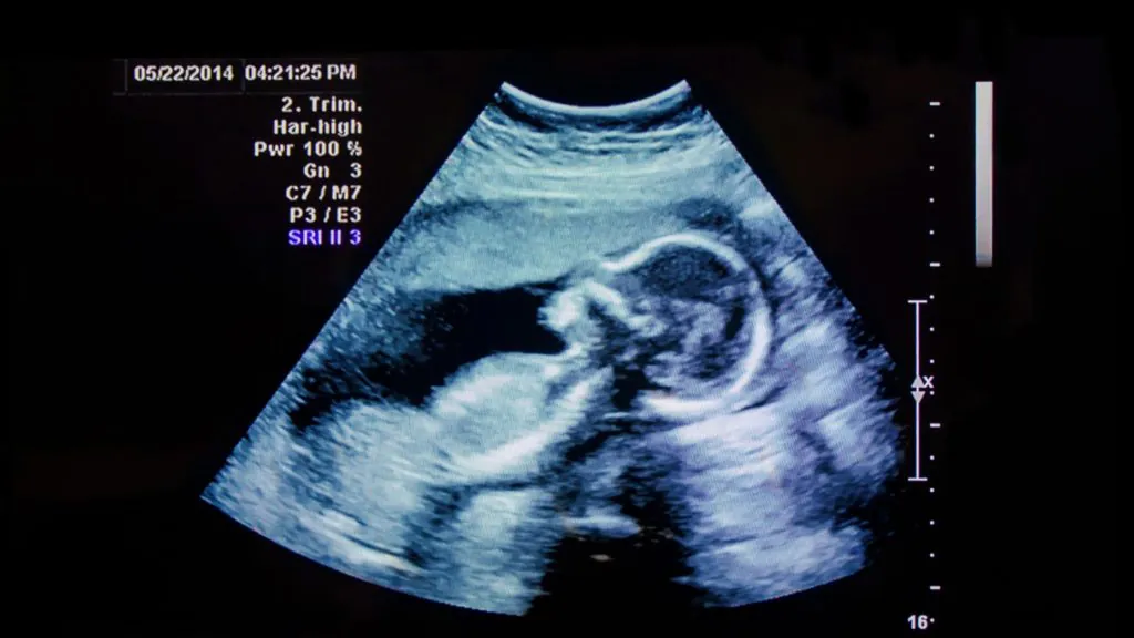 How can you tell gender on an ultrasound picture?