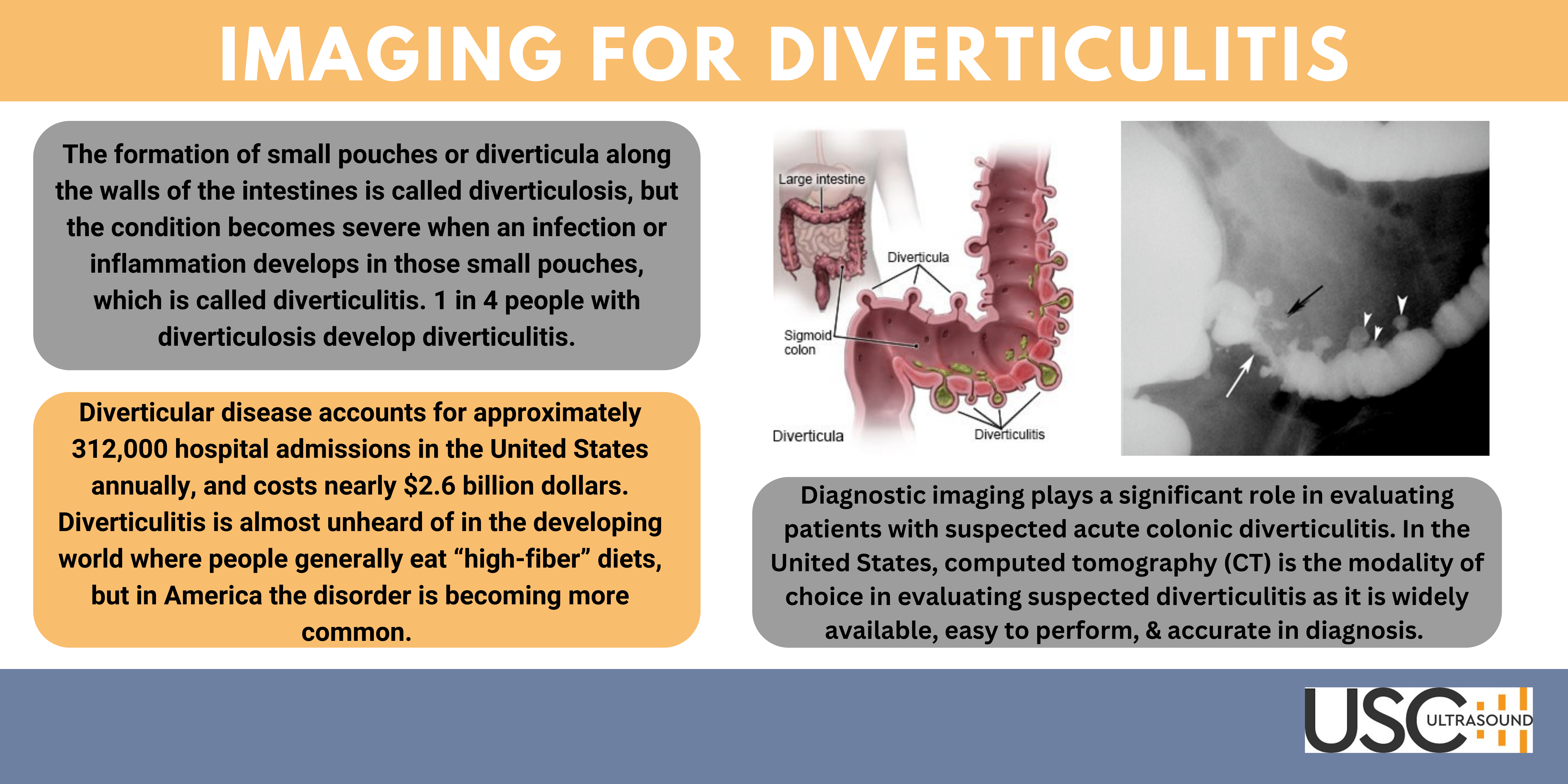 Imaging for Diverticulitis