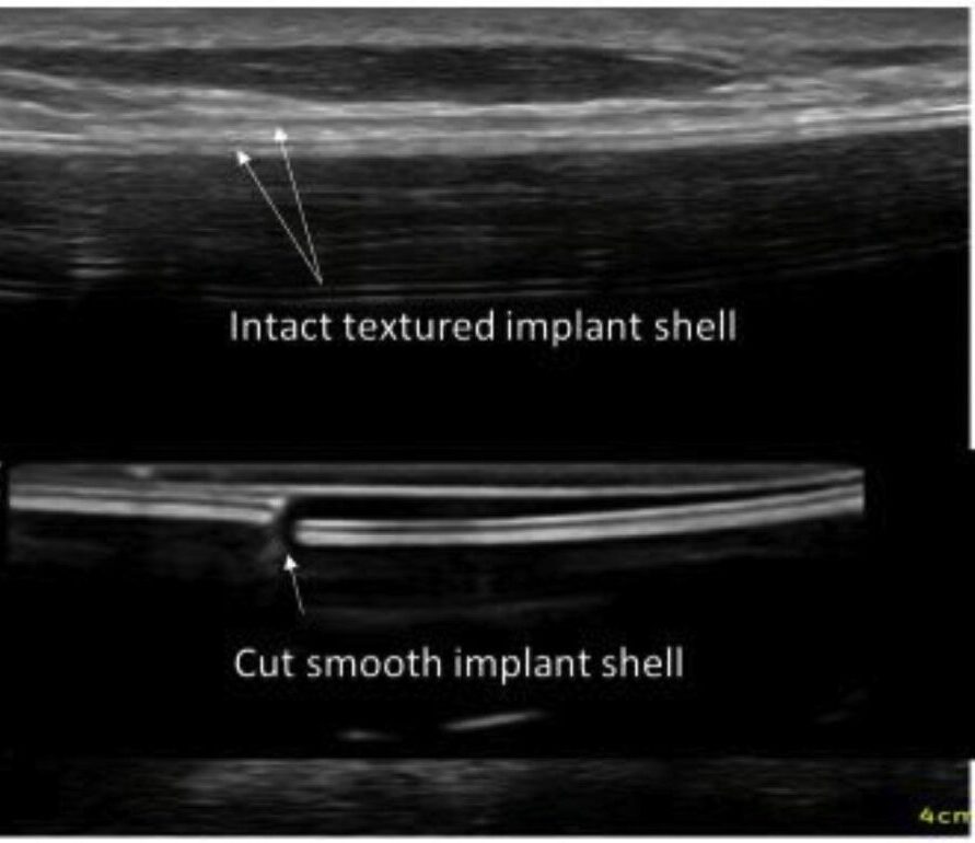 Breast Implant Ultrasound